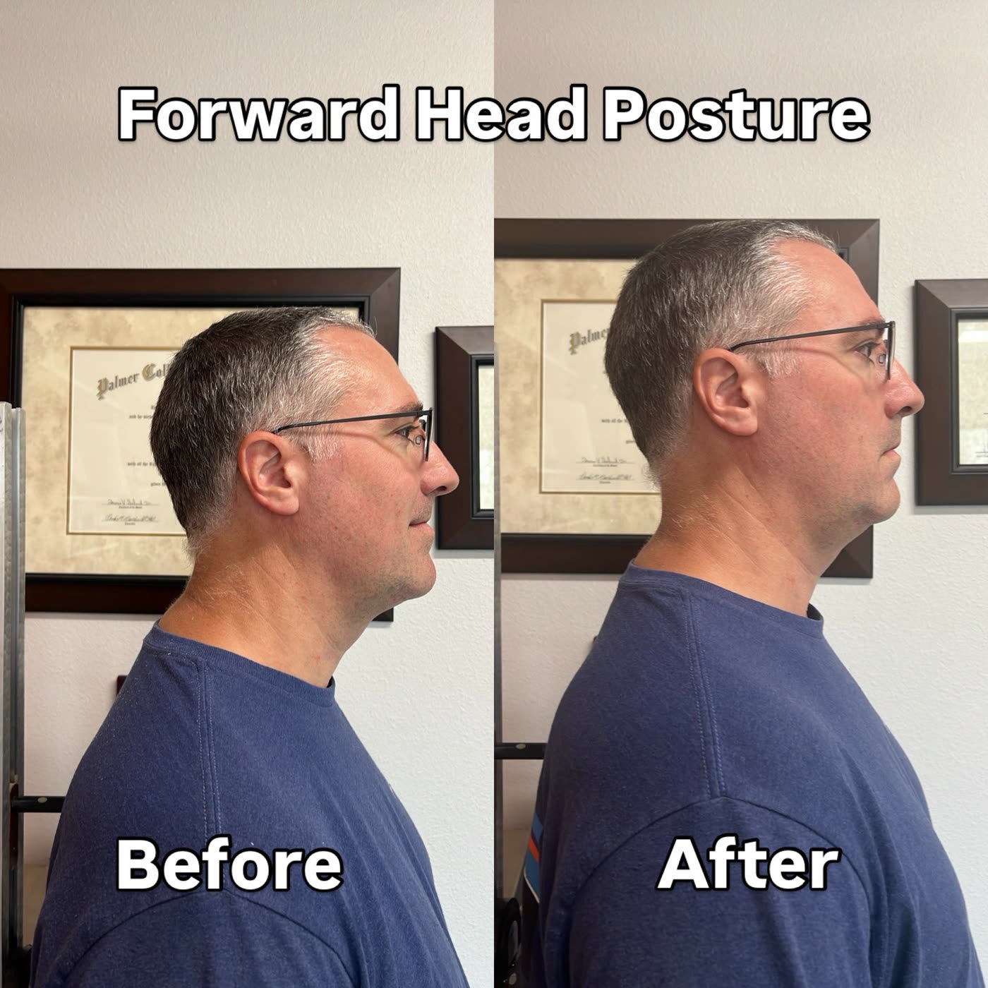 Before and after: forward head posture